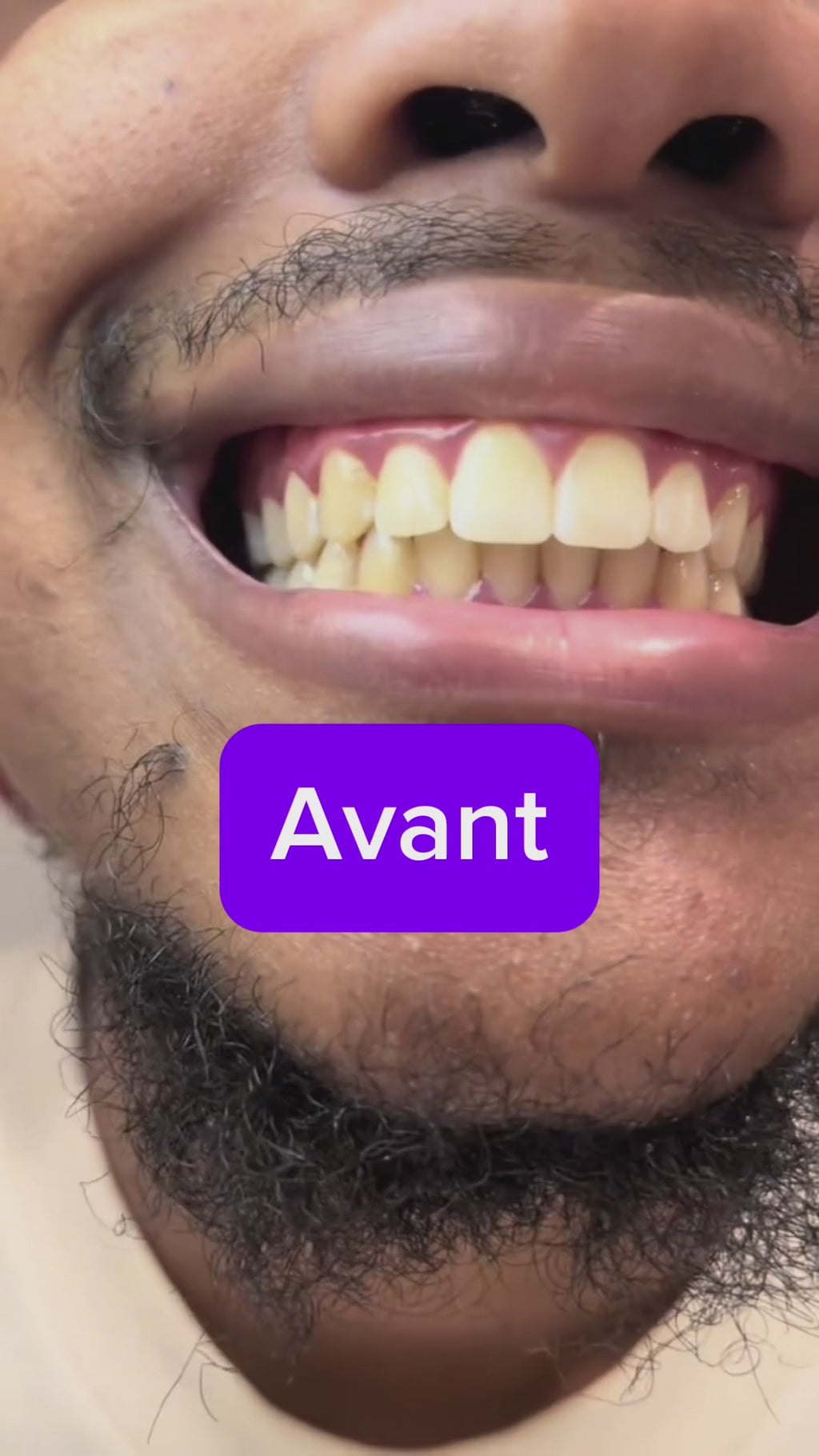 Poudre de blanchiments des dents hydroxyapatite